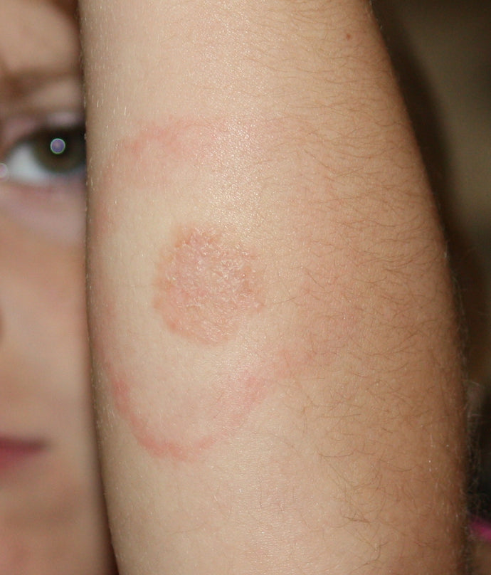 Lyme Disease